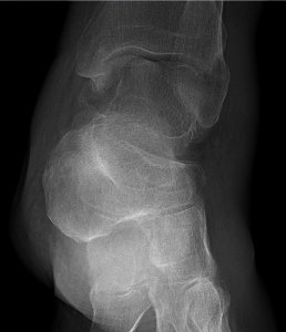 Calcaneal fragment - anteroposterior photo