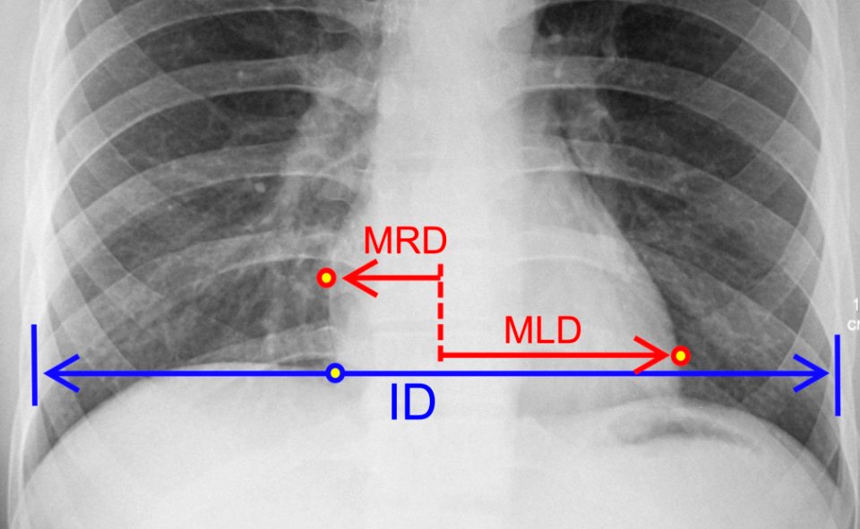 Cardiothoracic ratio