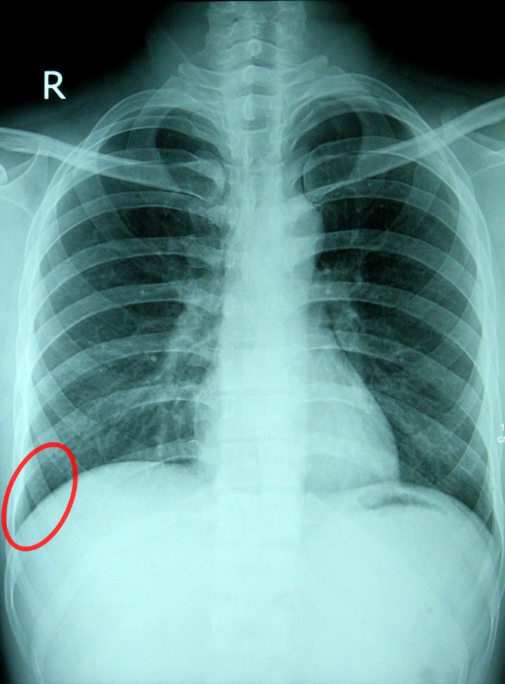 Costodiaphragmatic recess