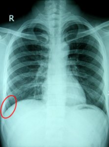 Costodiaphragmatic recess photo