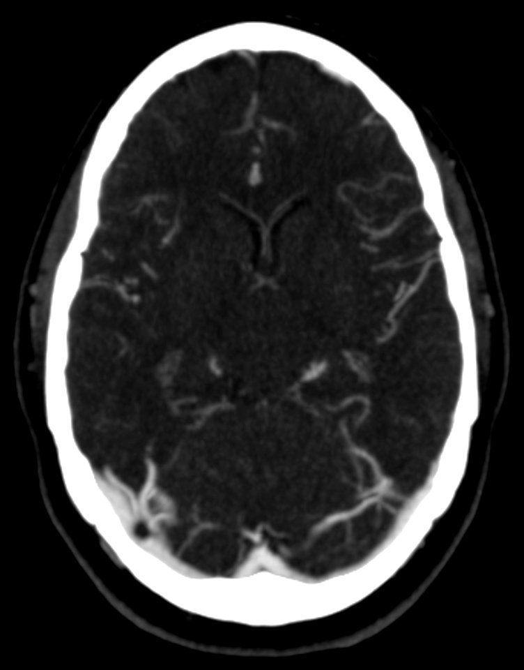 CT scan of a pacchionian body - transverse plane