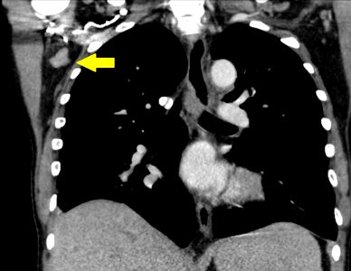CT of axillary lymphadenopathy - annotated