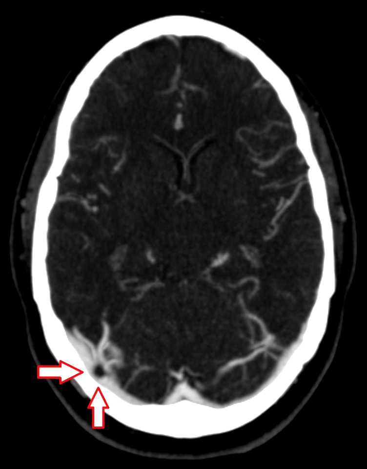 CT scan of a pacchionian body - transverse plane - labeled