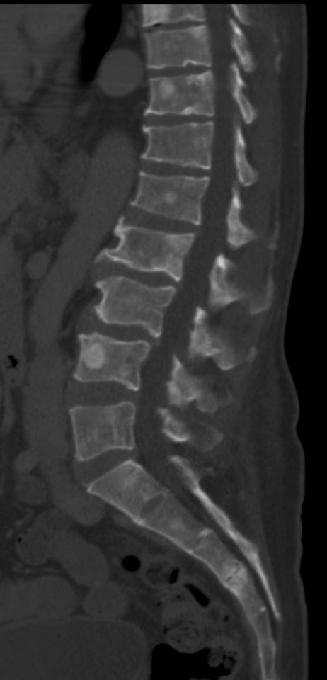 CT of osteoblastic lesions of multiple myeloma