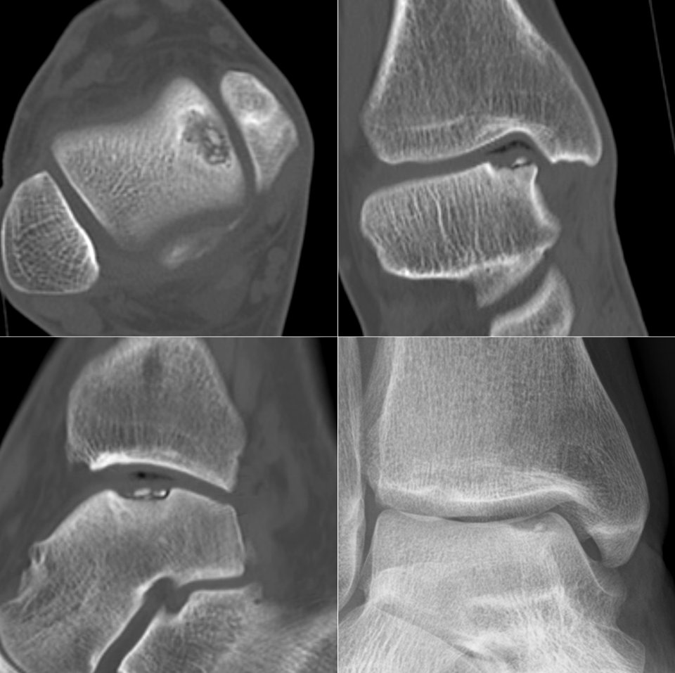 CT and projectional radiography of osteochondritis dissecans