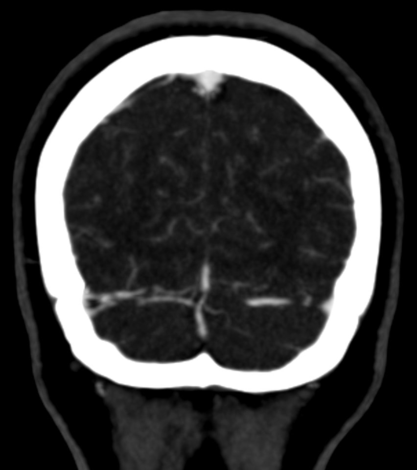CT scan of a pacchionian body - coronal plane