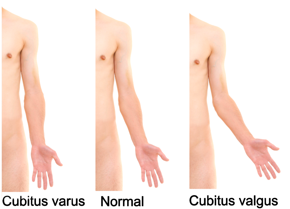 Cubitus varus and cubitus valgus