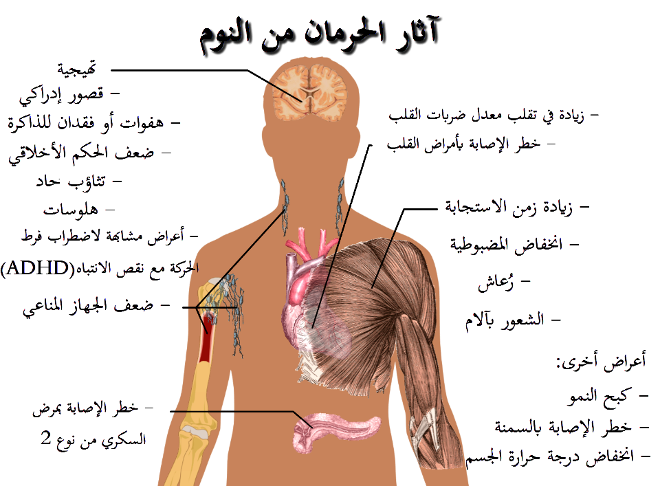 Effects of sleep deprivation-ar