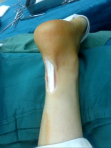 Achilles tendon 01 photo