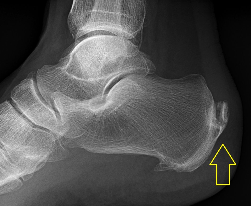 Achilles insertional calcific tendinosis (labeled)