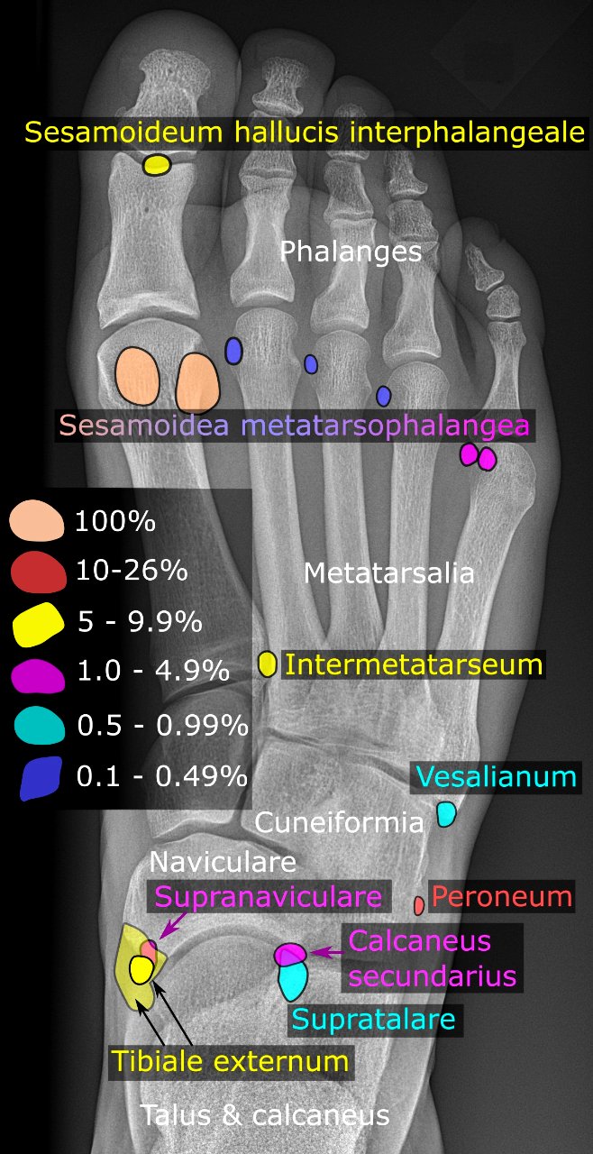 Accessory and sesamoid bones of the foot - dorsoplantar projection - la