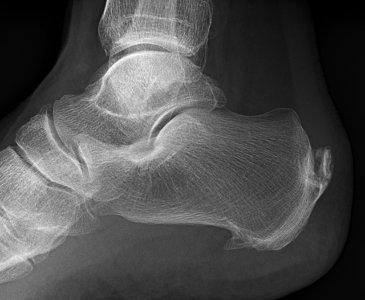 Achilles insertional calcific tendinosis photo