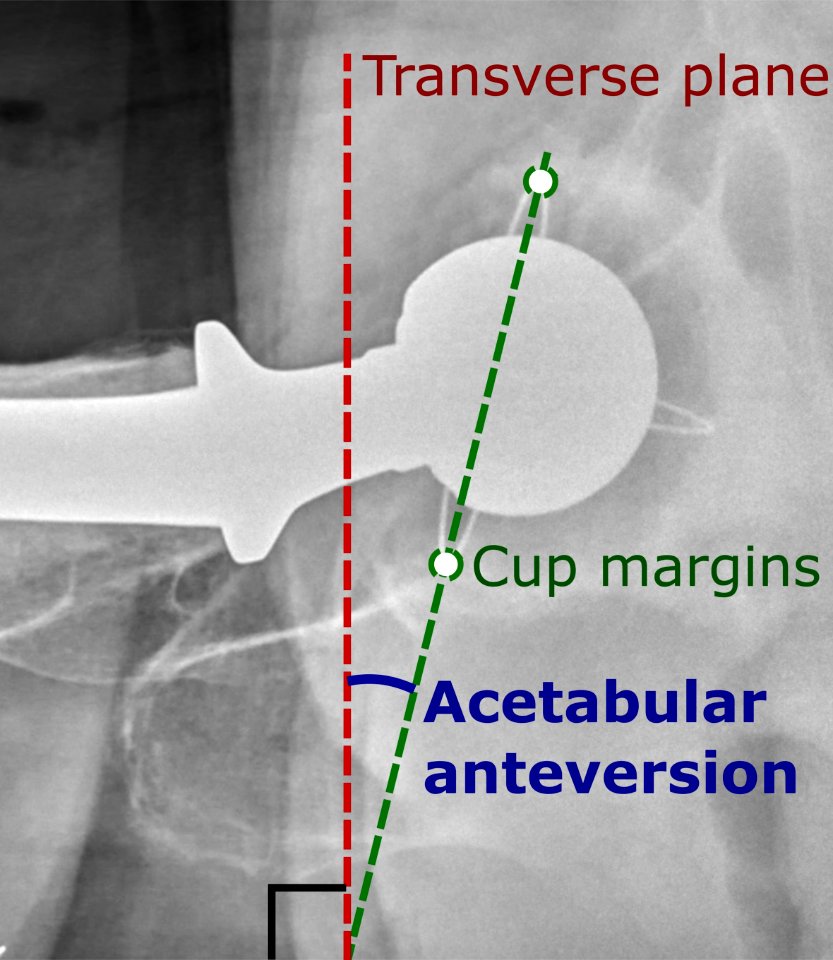 Acetabular anteversion of hip prosthesis