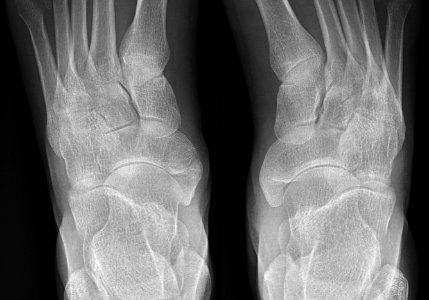 Accessory and cornuate navicular bone on dorsoplantar X-ray photo