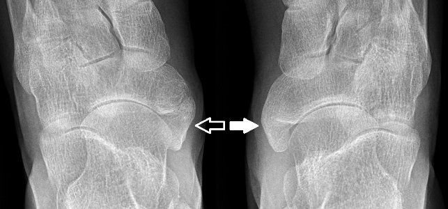 Accessory and cornuate navicular bone on dorsoplantar X-ray - annotated photo