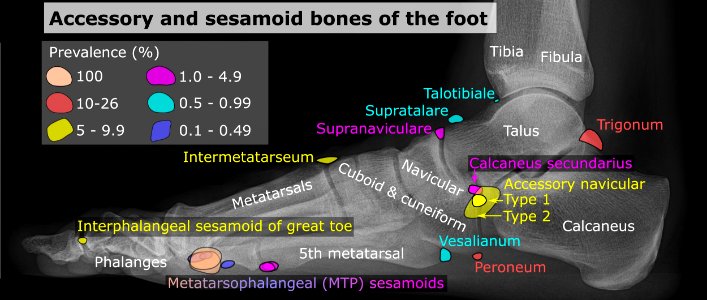 Accessory and sesamoid bones of the foot - lateral projection photo