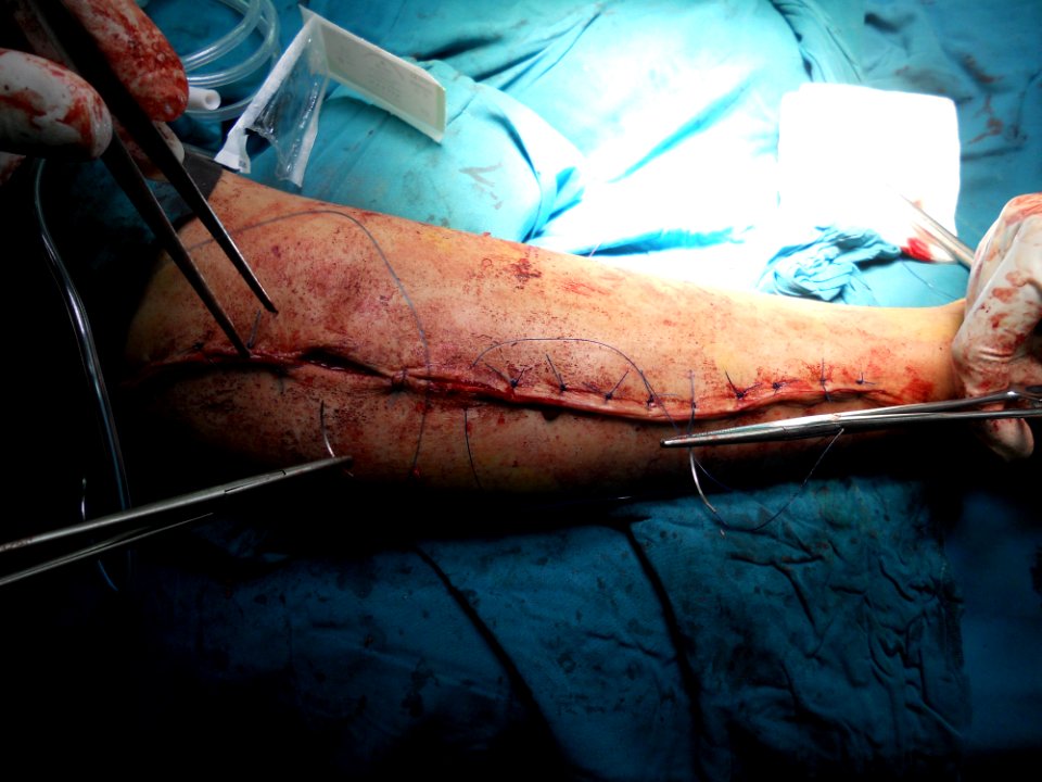 After orthopedic surgery