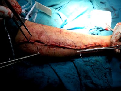 After orthopedic surgery