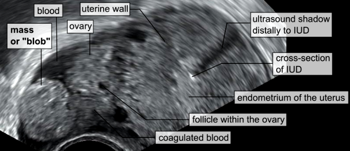 Blob sign of ectopic pregnancy photo