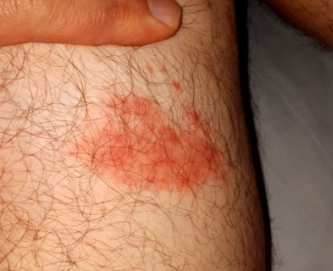 Atypical erythema migrans 1 week after initial presentation