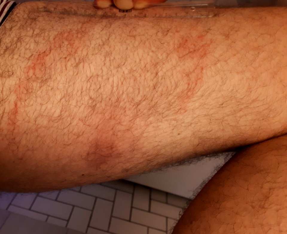 Approximately 8 weeks old erythema migrans on the thigh