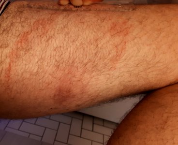 Approximately 8 weeks old erythema migrans on the thigh