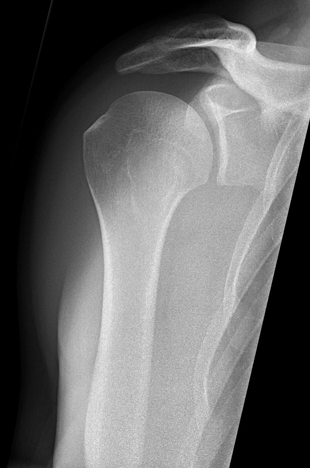 Anteroposterior glenoid (Grashey view) X-ray of a normal shoulder