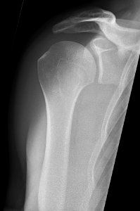 Anteroposterior glenoid (Grashey view) X-ray of a normal shoulder photo