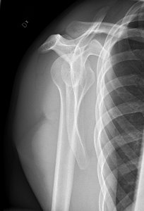 Y-projection X-ray of a normal shoulder photo