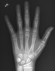 X-ray of a hand before automatic bone age calculation photo
