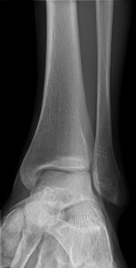 X-ray of normal ankle - 15 degrees internal rotation