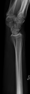 X-ray of normal wrist by lateral projection photo
