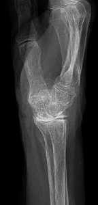 X-ray of a dorsally tilted wrist joint photo