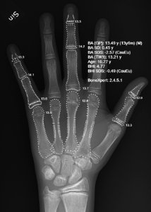 X-ray of a hand with automatic bone age calculation photo