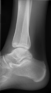 X-ray of normal ankle - lateral photo