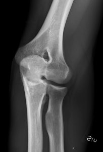 X-ray of normal elbow by 30 degrees external oblique projection photo