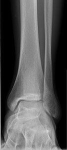X-ray of normal ankle - frontal photo