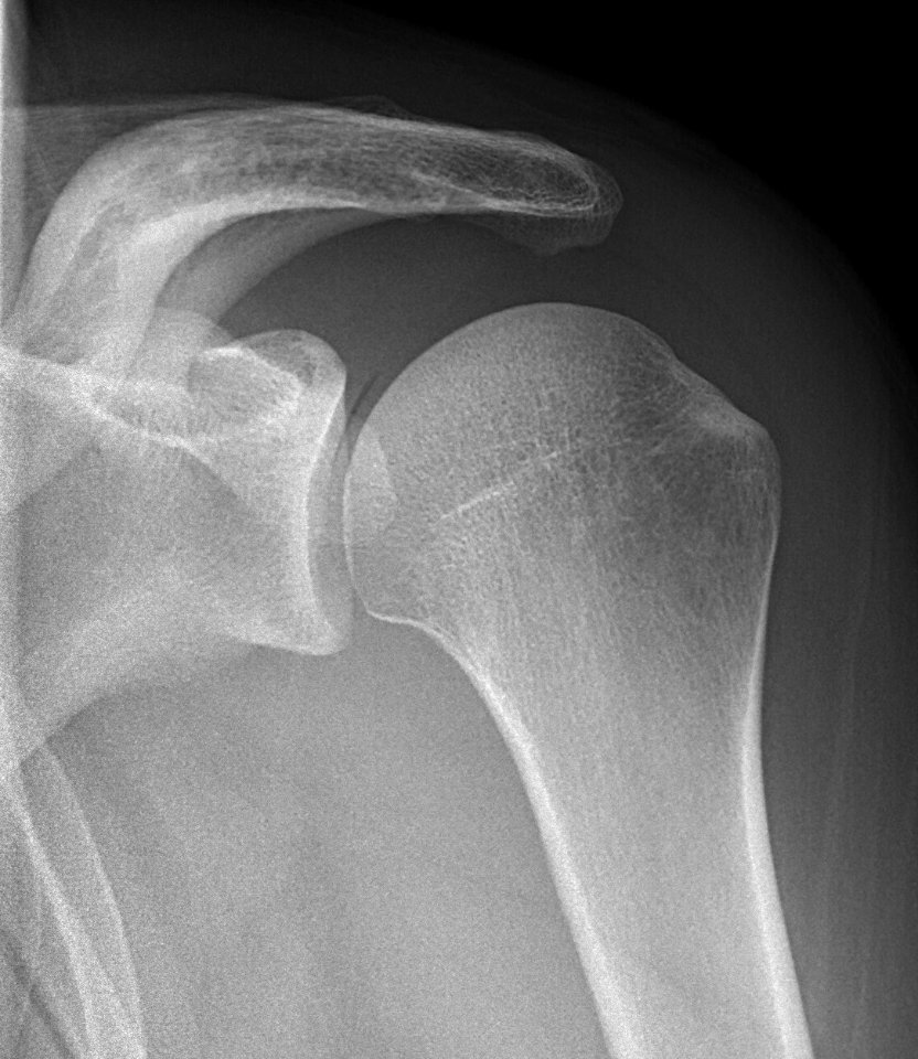 X-ray of shoulder with vacuum sign