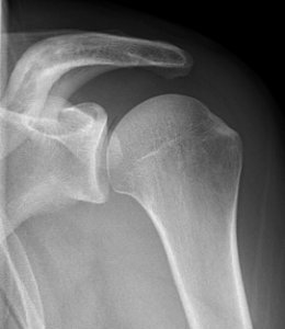 X-ray of shoulder with vacuum sign photo