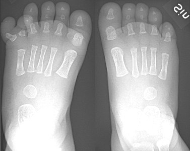 X-ray of feet in polydactyly photo
