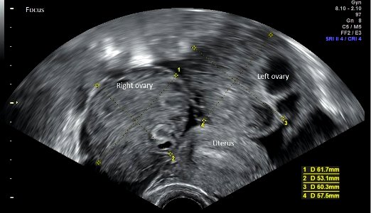 Vaginal ultrasonography in mild ovarian hyperstimulation syndrome - coronal