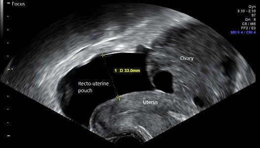 Vaginal ultrasonography in mild ovarian hyperstimulation syndrome - sagittal