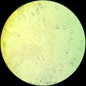 Vaginal wet mount with clue cells photo