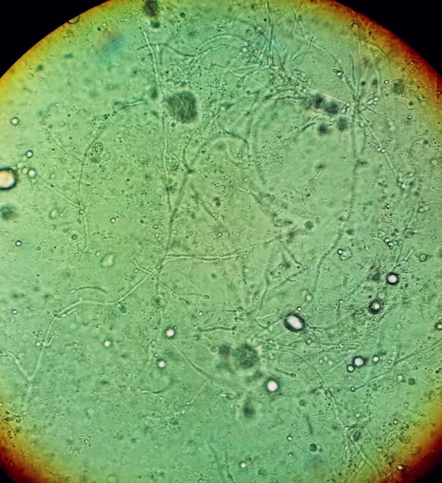 Vaginal wet mount in candidal vulvovaginitis