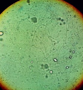 Vaginal wet mount in candidal vulvovaginitis