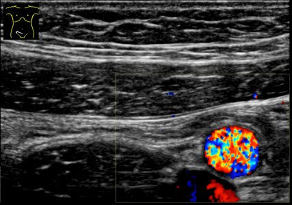 Ultrasonography of a normal appendix