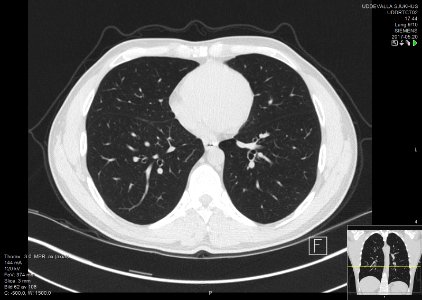 High-resolution computed tomograph of a normal thorax, axial plane (62)