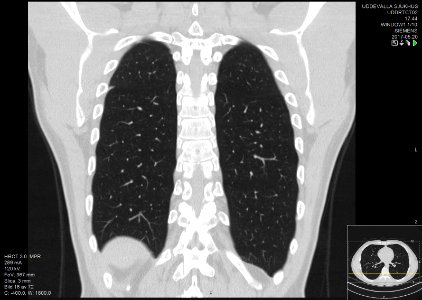 High-resolution computed tomograph of a normal thorax, coronal plane (54)