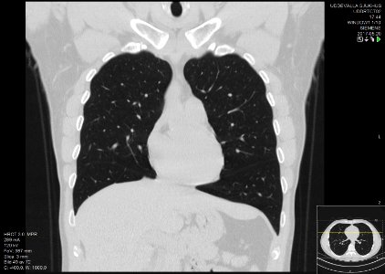 High-resolution computed tomograph of a normal thorax, coronal plane (21)