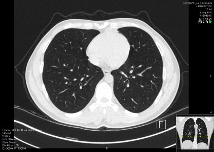 High-resolution computed tomograph of a normal thorax, axial plane (65)